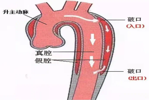 主动脉夹层，年轻小伙急转威院