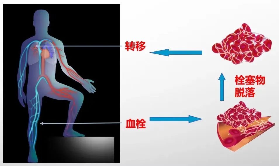 洲际飞行警惕“经济舱综合征”