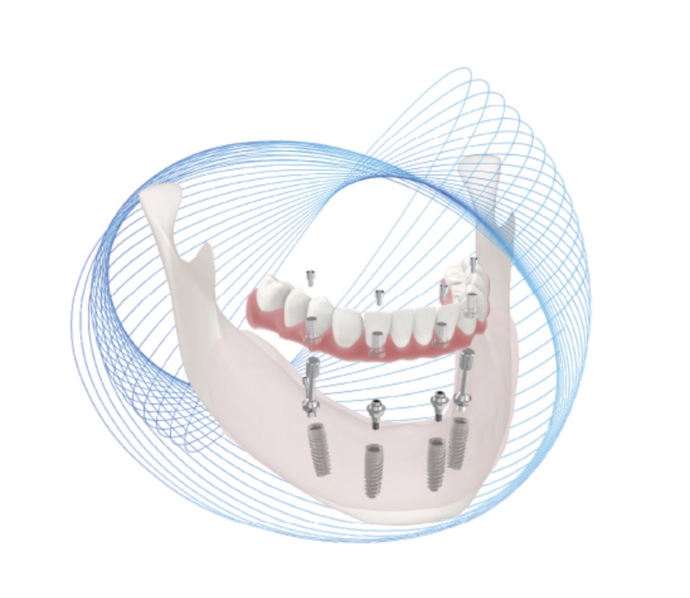 科特斯无牙颌解决方案丨Cortex Edentulous Solutions