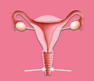 高危HPV16、58（+）宫颈3点、6点HSIL（CIN2级）伴鳞状上皮化生