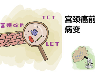 #HPV转阴# NIC3锥切术后VaINI级、HPV阳性感染电灼结合红卡治疗#妇科宫颈健康#HPV超话健康超话#女性健康# ​​​
