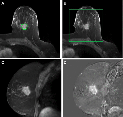 New AI Tool Detects Possible Metastatic Breast Cancer by Improving MRI Sensitivity