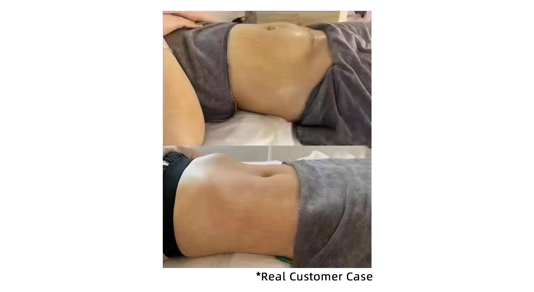 Effective Body Contouring