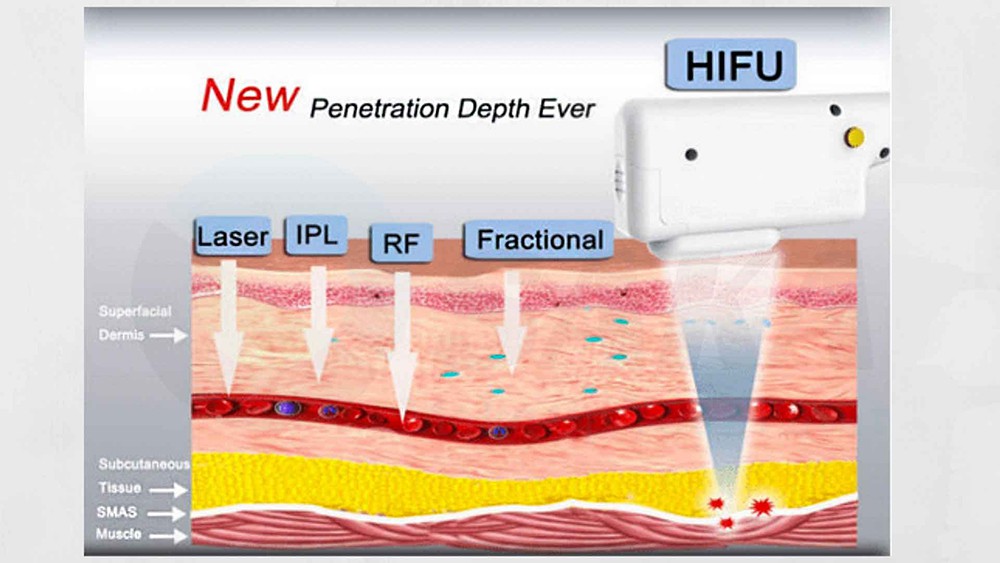 Advanced Non-Invasive Facelift and Fat Reduction