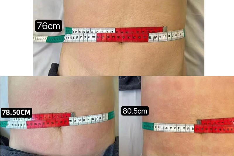 Quick Fat Reduction with Long-Lasting ResultsTreatment Options