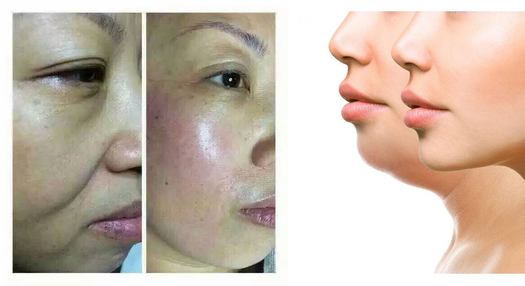 HIFU Before and After Results – Face Lift and Skin Tightening