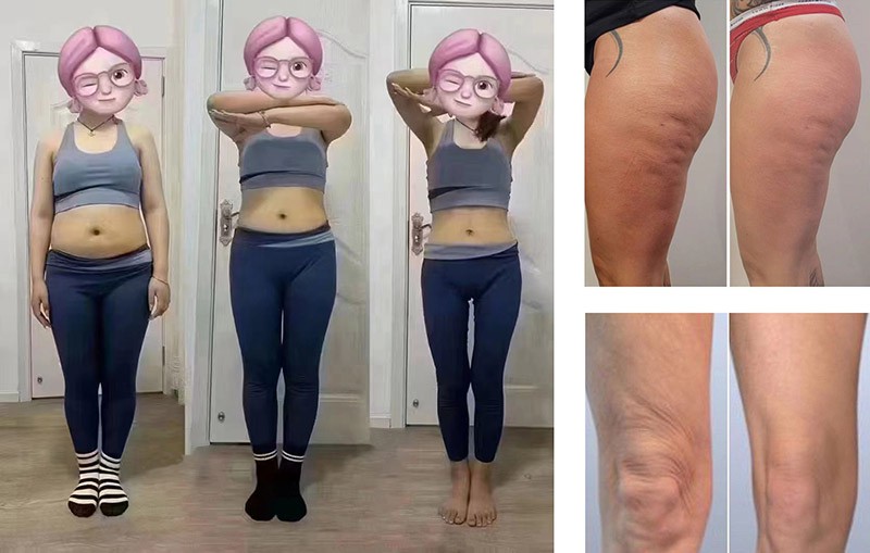 HIFU Machine Before and After Results – Body Contouring and Fat Reduction