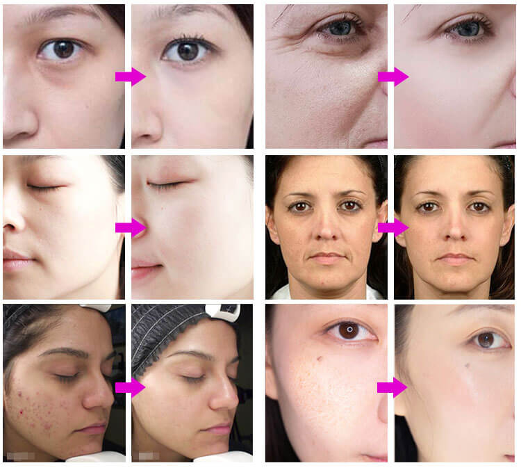 8.	PDT Light Therapy Machine: Before and After Results