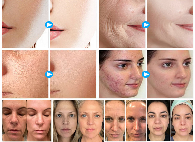 8.	PDT Light Therapy Machine: Before and After Results