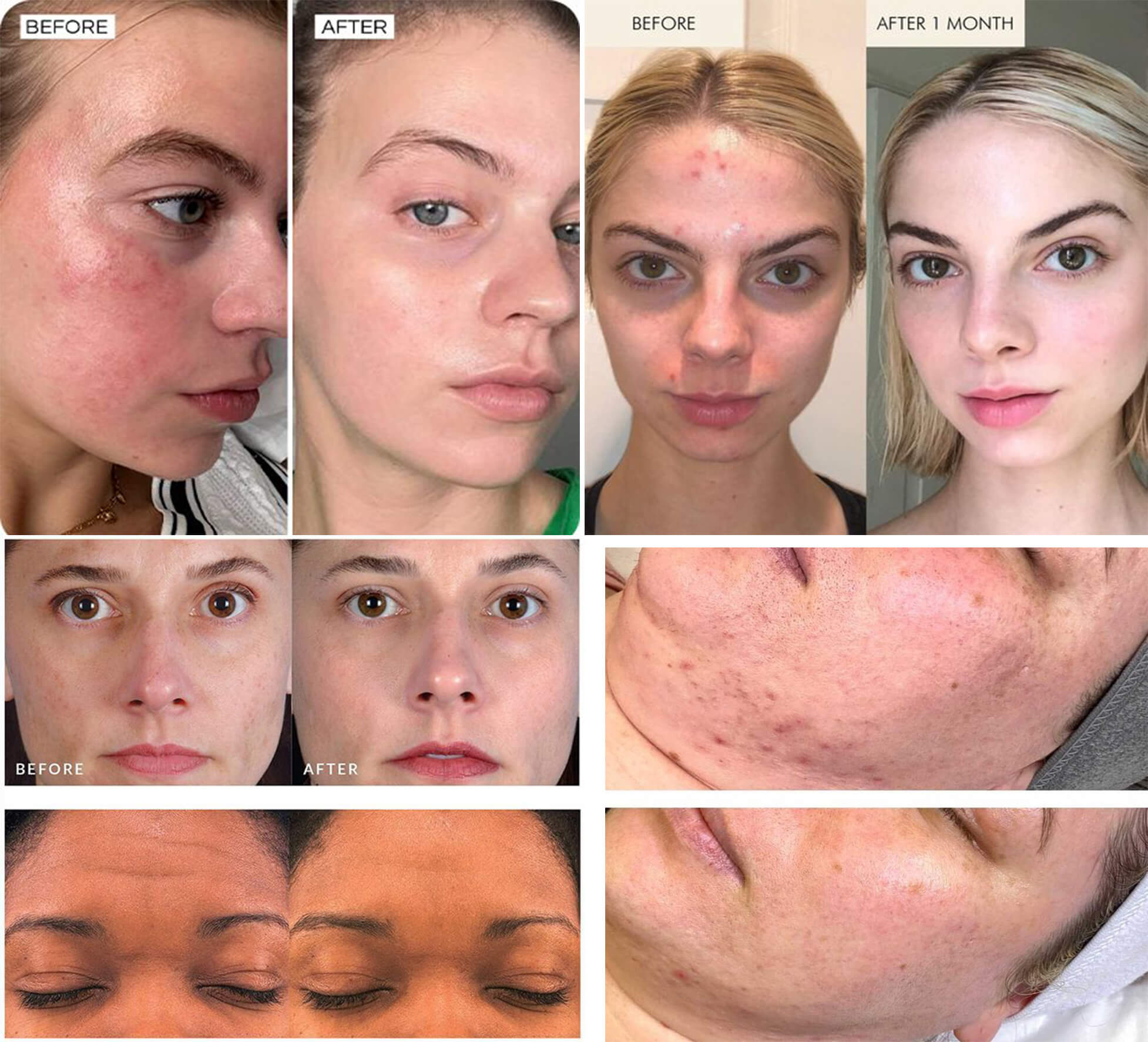 Noticeable results after one treatment, with optimal results after six sessions