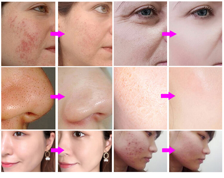  Microdermabrasion before and after