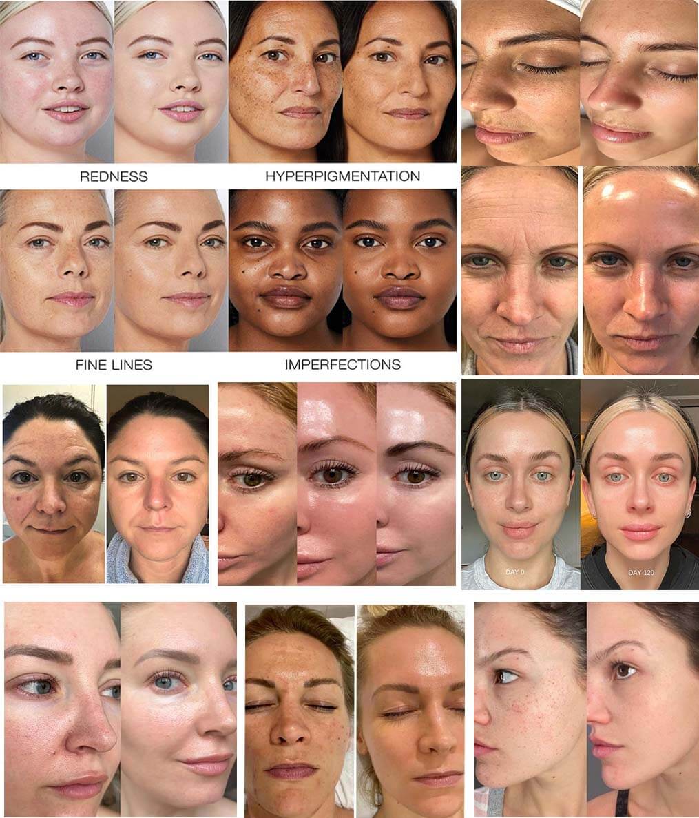 Hydrafacial before and after