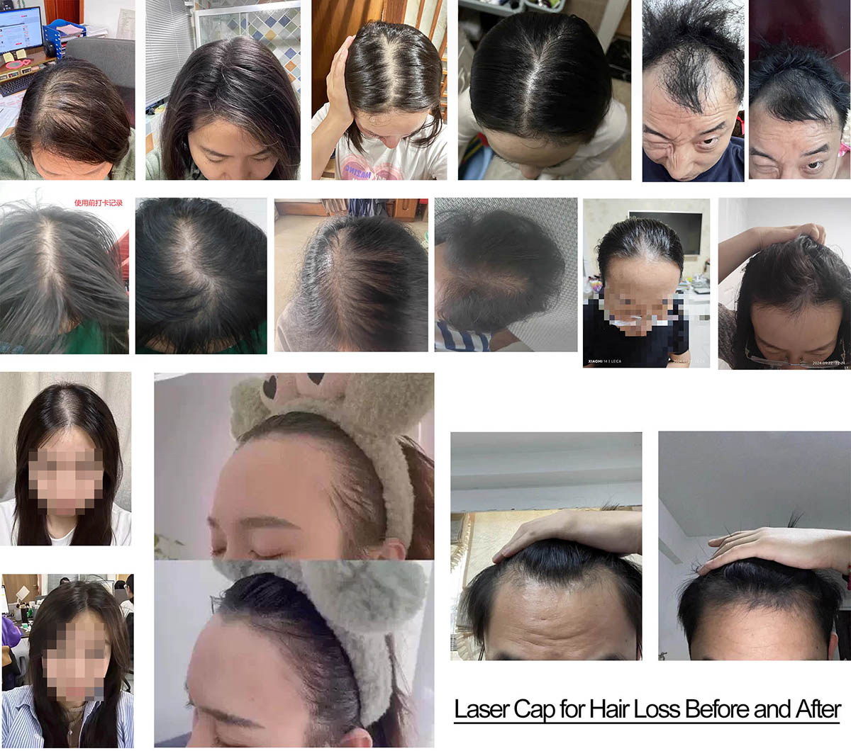 Laser Cap for Hair Loss Before and After