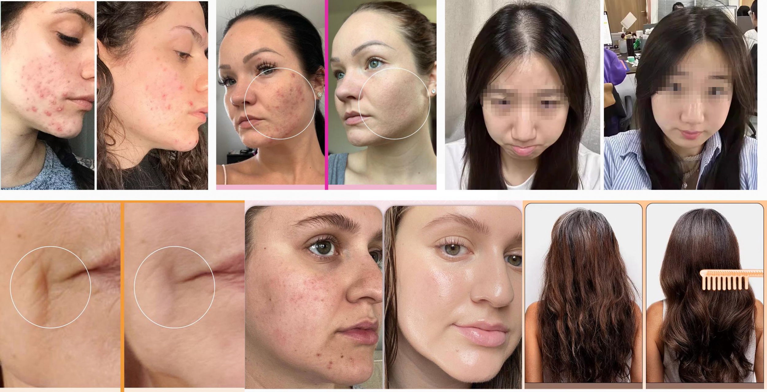 Ubeautnow High Frequency Wand Before and After