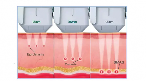 Best HIFU Machine 2026: Top Ultrasound Skin Tightening Devices for Clinic & Home (Before & After + R...