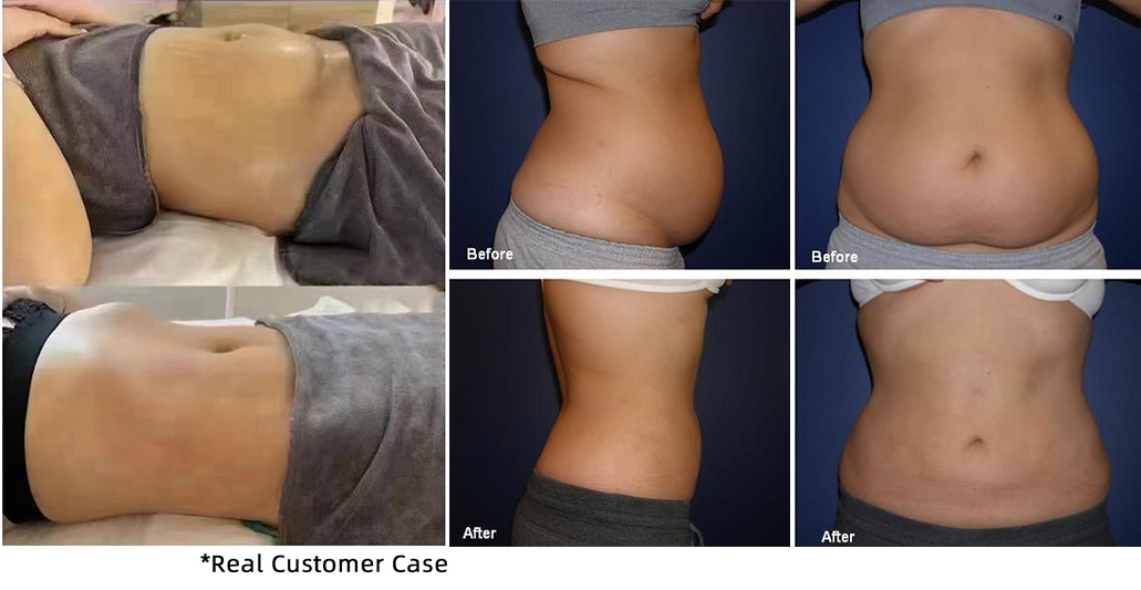 Best Laser Lipo Machine 2026: Top Fat Reduction Machines for Home & Clinics (Before & After Results)