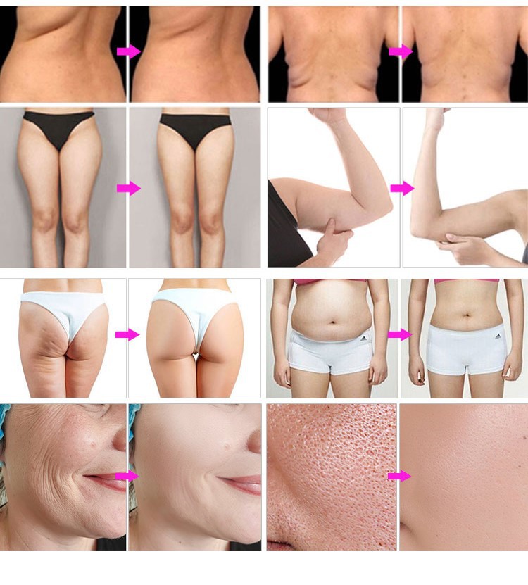 Best Cavitation Machine 2026 – Ultrasonic Fat Reduction + Before & After Results