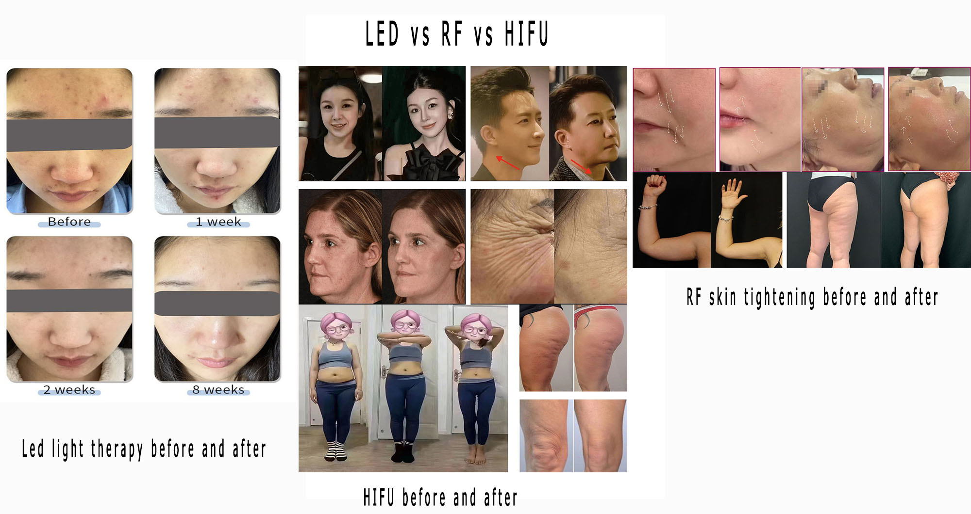 LED vs RF vs HIFU: Which One Really Works? Results, Before & After & Best Treatment Guide (2026)