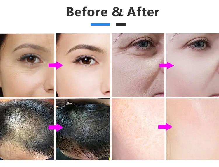 Ubeautnow Needle Free Mesotherapy Machine – RF EMS Skin Rejuvenation & Facial Hydration Device