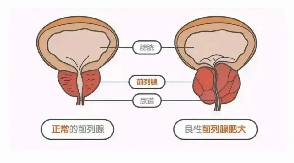 前列腺增生出现尿频尿急时，少喝水能解决问题吗？
