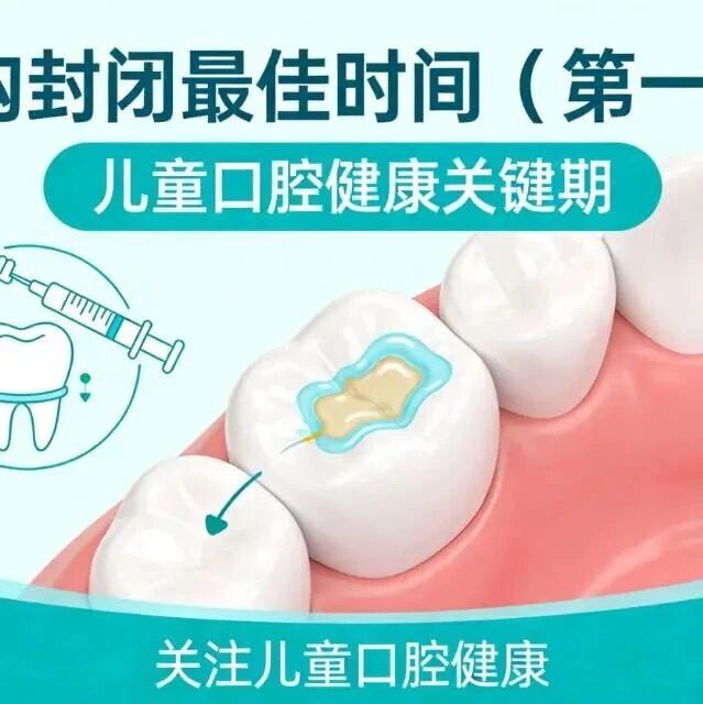 窝沟封闭 vs 涂氟最佳时间，你知道吗？
